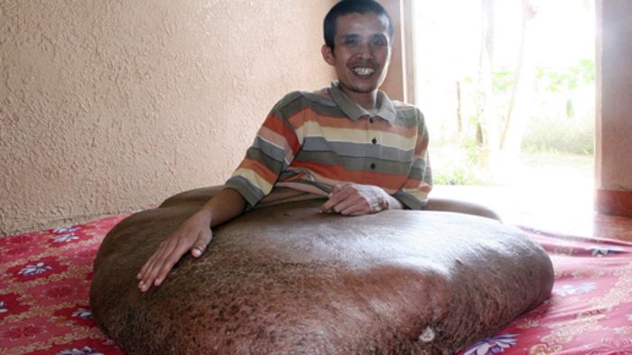 Ärzte entfernen 90 Kilo-Tumor in Vietnam